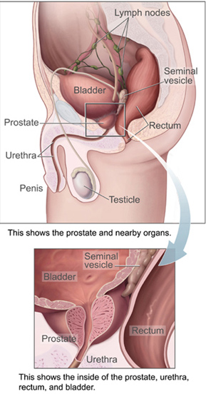Prostate Cancer Diagram
