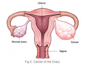 Female reproduction system with ovarian cancer in one ovary